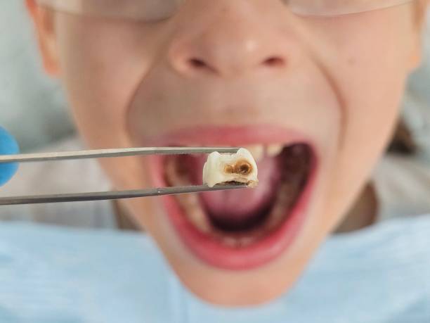 Best Root Canal Emergency Dentist  in Galena Park, TX